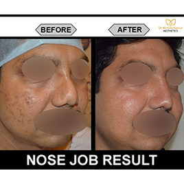 rhinoplasty-img8